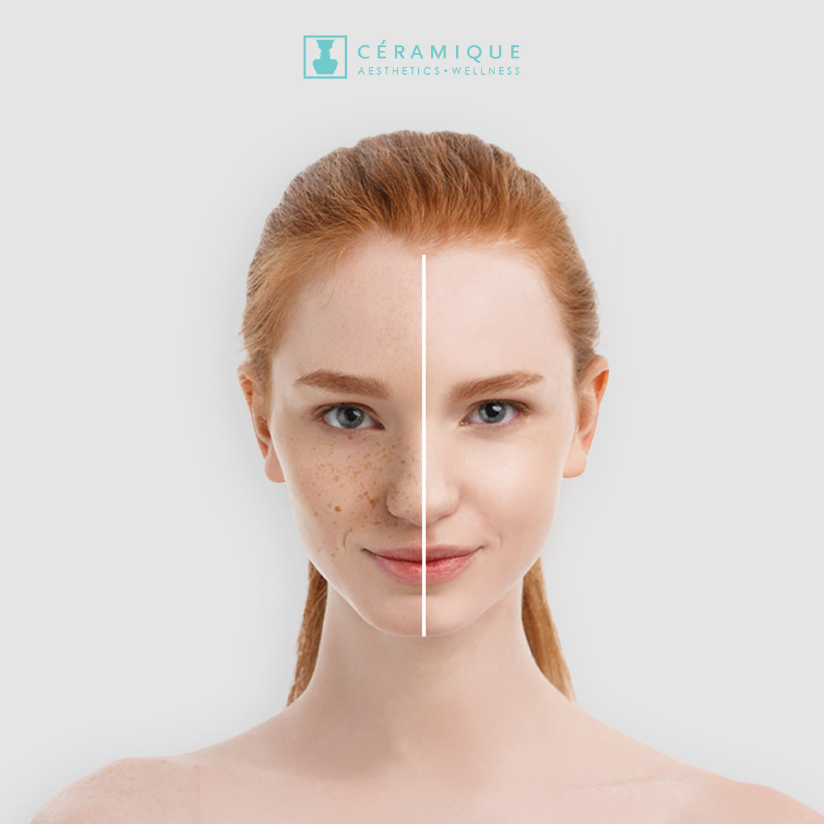 Ceramique facial treatment